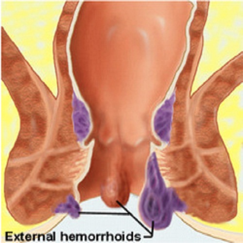 External Hemorrhoids Cure mjh4zbv